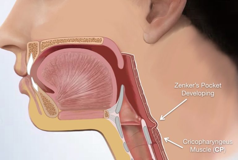 دکتر دیورتیکول زنکر - کرج